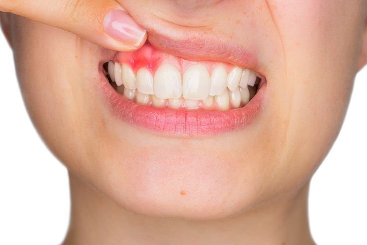 Gum Disease Treatment